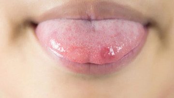 Nhiệt miệng ở lưỡi có đáng lo không?