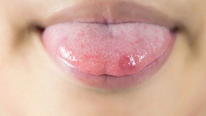 Nhiệt miệng ở lưỡi có đáng lo không?