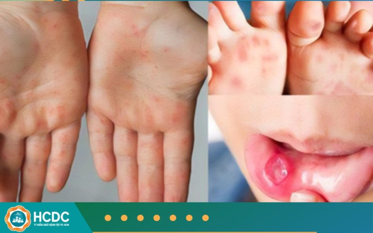 TP. Hồ Chí Minh ghi nhận 3 ca tử vong vì tay chân miệng, dịch có dấu hiệu “nóng” trở lại