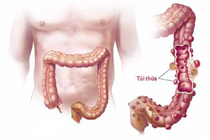Viêm túi thừa đại tràng: Nguy cơ tiềm ẩn và cách điều trị, phòng ngừa