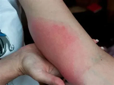 Mẹo giảm sưng khi bị ong đốt