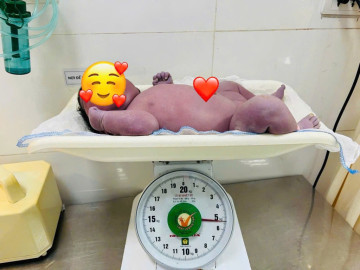 Kỳ tích sản khoa: Bé trai 5,4kg chào đời an toàn từ sản phụ trên nền sẹo mổ cũ