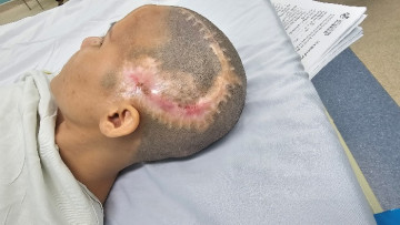 60 phút làm đẹp đổi lấy biến chứng kinh hoàng: Cô gái 33 tuổi đột quỵ, mất mảng sọ lớn