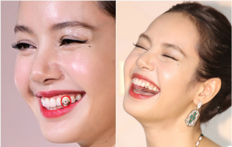 Gắn đá lên răng: Làm đẹp hay tiềm ẩn rủi ro?