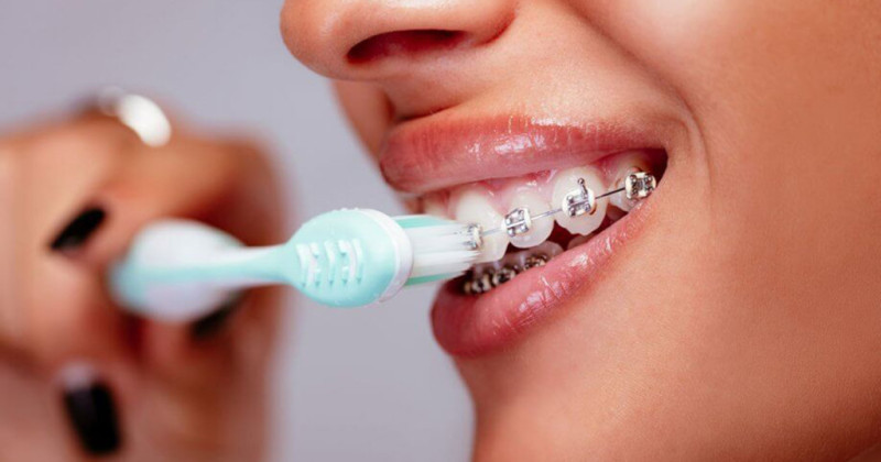 Vệ sinh thế nào khi niềng răng để tránh viêm lợi?