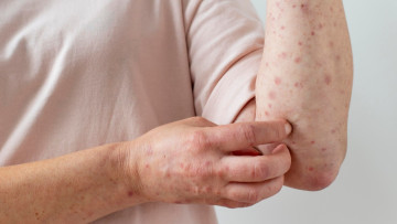 Thủy đậu có bị lại không?