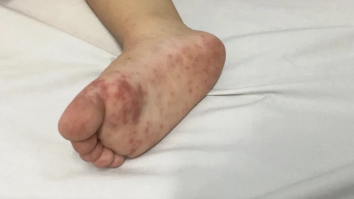 Tay chân miệng gia tăng, đã ghi nhận 8 ca tử vong trong cả nước