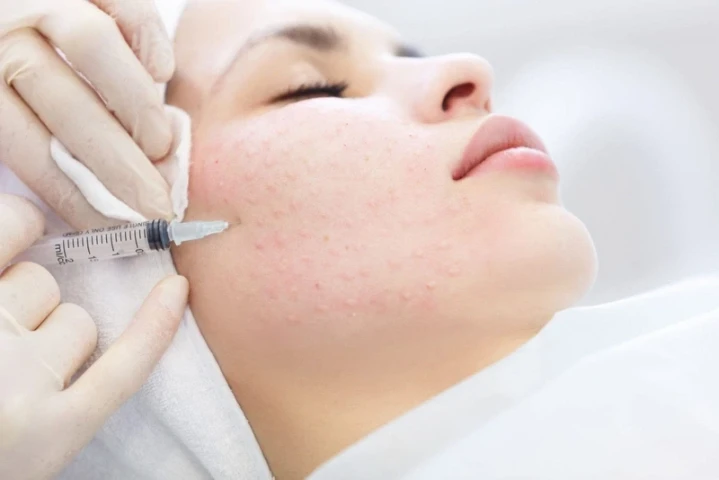 Da nhiễm corticoid có nên tiêm meso?