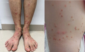 Miền Bắc ghi nhận nhiều ca sẩn ngứa do bọ chét trong mùa nóng