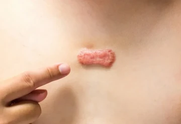 Cây bìm bịp hỗ trợ làm mềm sẹo lồi, giảm ngứa và căng tức