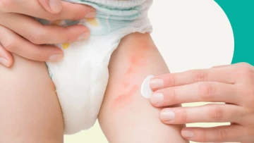Vì sao trẻ đột ngột nổi mẩn đỏ?