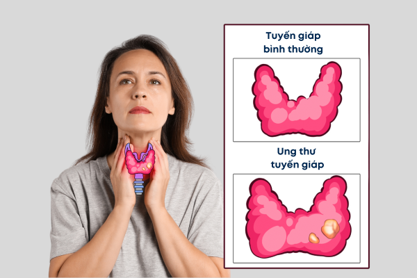 Ung thư tuyến giáp: Nhận diện sớm, tăng cơ hội điều trị hiệu quả