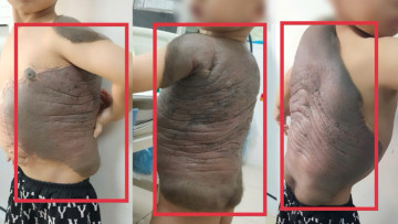 Bé trai mang khối u “mai rùa” suốt 7 năm lần đầu tiên đứng thẳng sau 6 lần đại phẫu