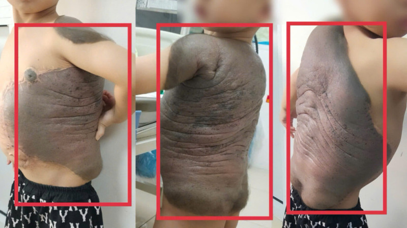 Bé trai mang khối u “mai rùa” suốt 7 năm lần đầu tiên đứng thẳng sau 6 lần đại phẫu