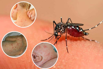 Hết sốt chưa hết nguy hiểm: Cảnh báo biến chứng sốt xuất huyết