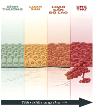 Loạn sản độ cao: Cảnh báo sớm trước “ngưỡng cửa” ung thư