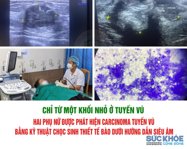 Phát hiện kịp thời 2 ca ung thư vú tại Trung tâm Y tế khu vực Hạ Hòa