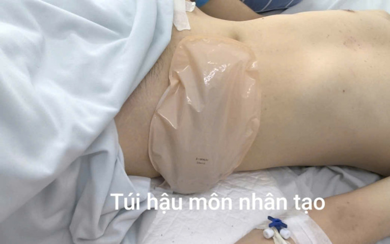 Tự nặn nhọt vùng mông, nam thanh niên phải làm hậu môn nhân tạo