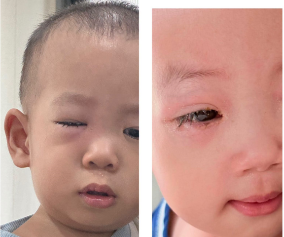 Cha mẹ không nên hoang mang khi trẻ mắc Adenovirus