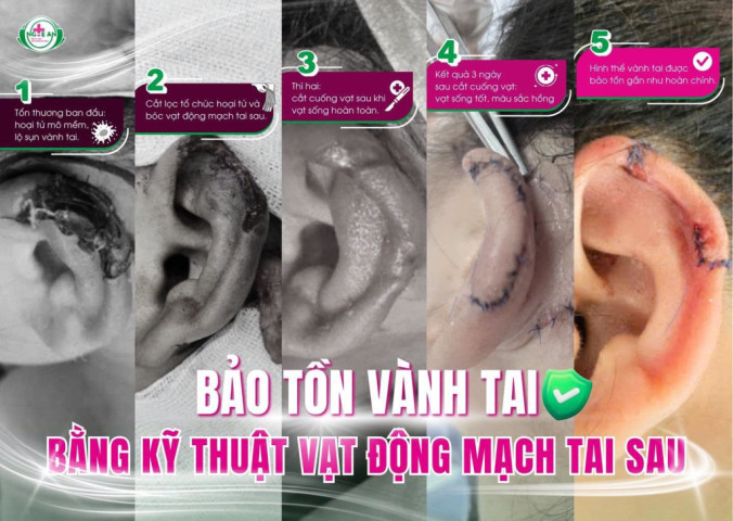 Nghệ An: Bảo tồn gần như nguyên vẹn vành tai cho nữ bệnh nhân bị mất 1/3 tai sau tai nạn sinh hoạt