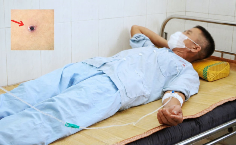 Sốt mò - Đừng để vết loét nhỏ trở thành dấu hiệu bỏ qua