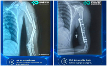 Nam Định: Gãy thân xương cánh tay phức tạp – phẫu thuật kết hợp xương bảo tồn thần kinh quay