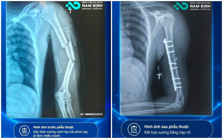 Nam Định: Gãy thân xương cánh tay phức tạp – phẫu thuật kết hợp xương bảo tồn thần kinh quay