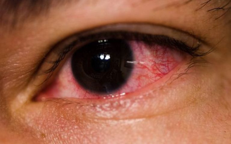 Cảnh báo tình trạng đau mắt - chủ động phòng bệnh để bảo vệ đôi mắt