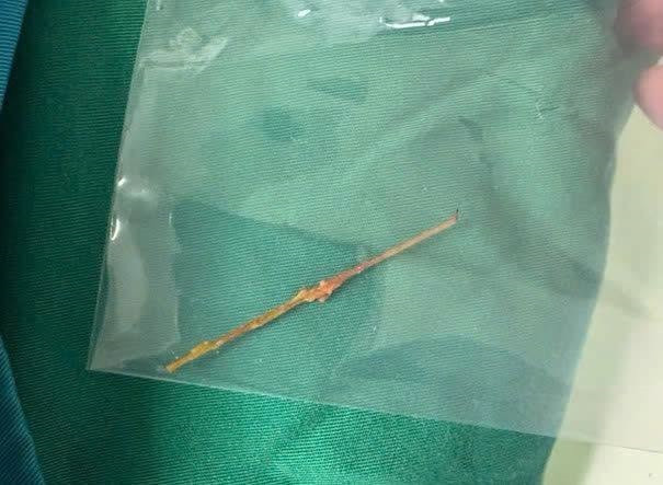 Phú Thọ: Phẫu thuật cấp cứu lấy chiếc tăm tre dài 7 cm xuyên thủng tá tràng