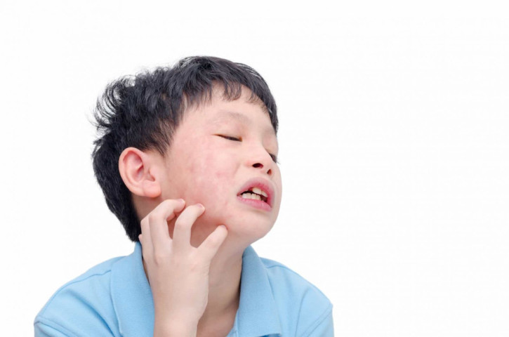 Dấu hiệu đầu tiên của quai bị dễ bị nhầm với cảm cúm