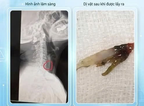 Phú Thọ: Cấp cứu kịp thời người bệnh hóc xương cá đâm ngang vào 1/3 thực quản