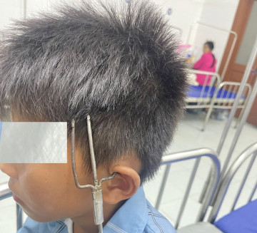Tuyên Quang: Kịp thời cấp cứu trẻ em bị dị vật sắc nhọn đâm xuyên từ vùng tai lên thái dương