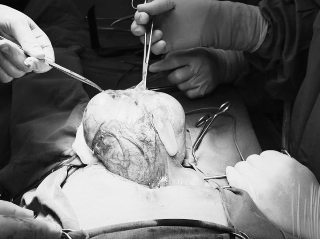 Điều trị thành công 1 trường hợp u nang buồng trứng trái kích thước lớn ở người bệnh 73 tuổi